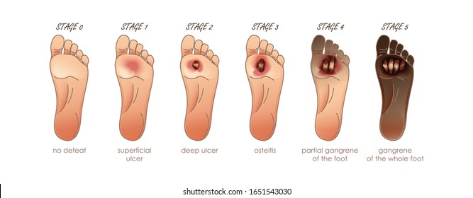 Diabetic Foot. Stages of defeat. Ulcers, skin sores on foot. Vector illustration for your design