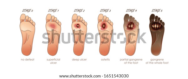 Stages Of Diabetic Foot Ulcer