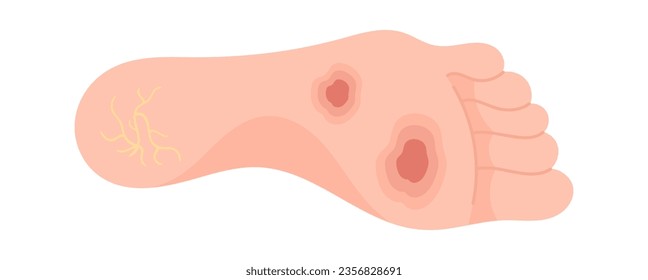 Diabetic Foot Symptom Vector Illustration