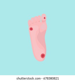 Diabetic Foot. Trophic Ulcers. Vector Illustration.