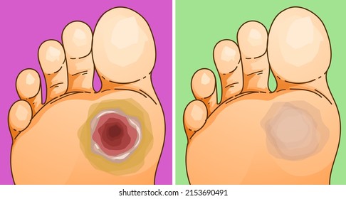 Diabetic Foot Ulcer. Healing of the diabetic foot ulcer. Before, after. Healthcare illustration.  Vector illustration. 