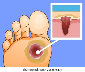 Diabetic Foot Ulcer. Healthcare illustration. Medical infographic. Vector illustration. 