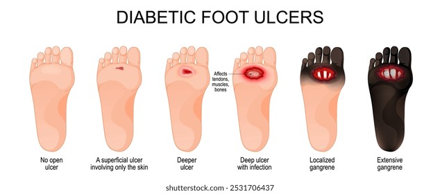 Úlceras diabéticas no pé. Classificação da gravidade do risco de ulceração à gangrena extensa e morte do tecido da perna. Cartaz vetorial