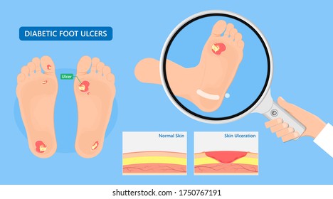 Diabetic Foot Ulcers VAC pain skin high feet sore heal exam test risk NPWT death blood sugar wound level treat nylon tissue eschar detect injury nerves stress semmes artery patient DFU