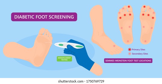 Diabetic Foot Ulcers VAC pain skin high feet sore heal exam test risk NPWT death blood sugar wound level treat nylon tissue eschar detect injury nerves stress semmes artery patient DFU