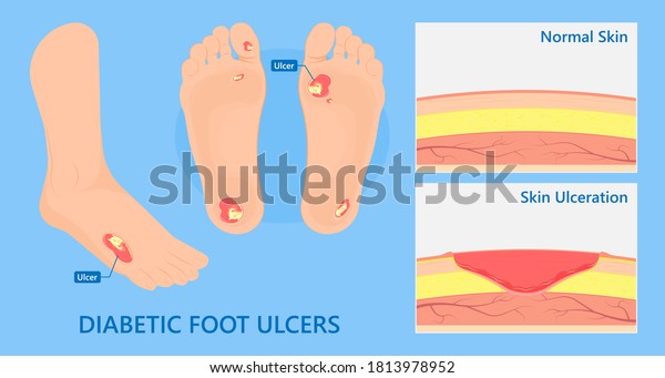 Diabetic Foot Ulcers Vac Pain Skin Stock Vector (Royalty Free ...