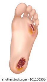 Diabetic foot. Vector illustration.