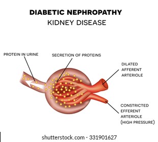 Diabetic Nephropathy causes the damage of glomerulus, kidney disease.