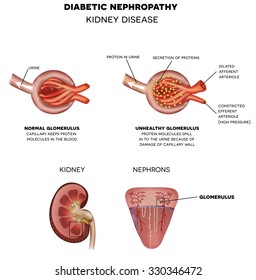 Diabetic Nephropathy, kidney disease.  Anatomy of renal corpuscle and glomerulus.