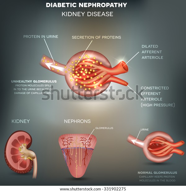 Diabetic\
Nephropathy, kidney disease.  Protein molecules spill in to the\
urine because of damage of capillary\
wall.