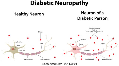 Diabetische Neuropathie