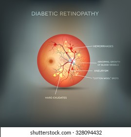 Diabetic retinopathy detailed anatomy on an abstract grey mesh background.