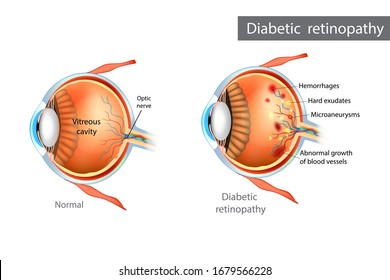 Diabetic retinopathy. Difference between Normal Retina and Diabetic Retinopathy