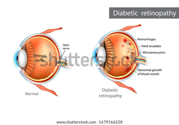 normal retina vs diabetic retinopathy optomap