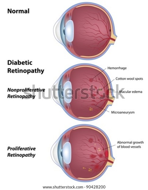 Diabetic retinopathy - disease of the eye as a\
result of diabetes