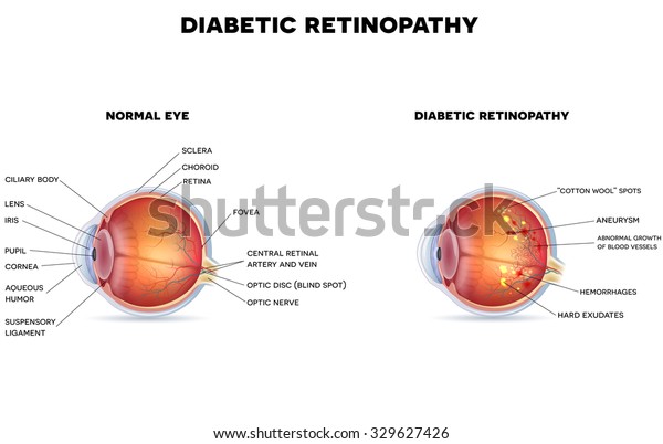Diabetic retinopathy\
and healthy eye\
anatomy.