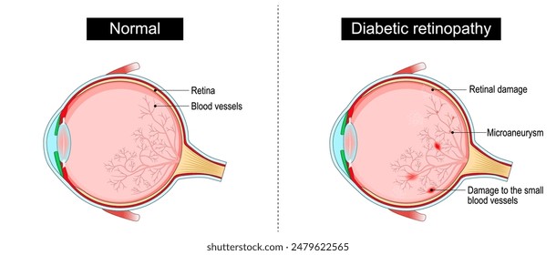 Diabetic retinopathy. Retinal damage. Cross section of human eye. Diabetes. Close-up of a macula, optic disc, choroid, retina, sclera, and fovea. Medical condition. Microaneurysm