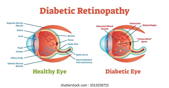 Diabetic Retinopathy vector illustration diagram, anatomical scheme. Medical educational information. 