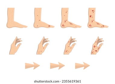 Diabetic, sugar feet vector illustration