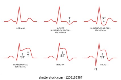 Diagnosis Myocardial Ischemia Vector / NSTEMI, STEMI