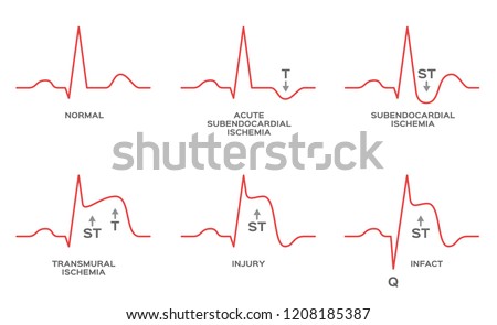 Ecg St Elevation Myocardial Infarction Stemi Stock Ve - vrogue.co