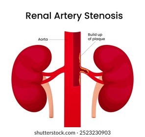 Diagnóstico da estenose da artéria renal