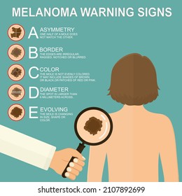 Diagnosis of skin cancer. Melanoma warning signs. Dermatological screening. UVB prevention of squamous cell treatment. Basal test. ABCDEs of skin cancer screening. 