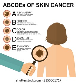 Diagnosis of skin cancer. Melanoma warning signs. Dermatological screening. UVB prevention of squamous cell treatment. Basal test. ABCDEs of woman skin cancer screening. 