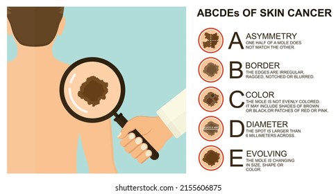 Diagnosis of skin cancer. Melanoma warning signs. Dermatological screening. UVB prevention of squamous cell treatment. Basal test. ABCDEs of skin cancer screening. Man back view