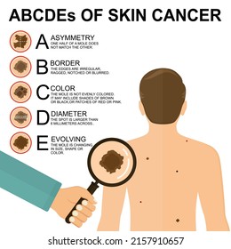 Diagnosis of skin cancer. Melanoma warning signs. Dermatological screening. UVB prevention of squamous cell treatment. Basal test. ABCDEs of skin cancer screening. Man back view