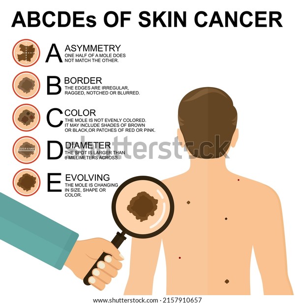 Diagnosis of skin
cancer. Melanoma warning signs. Dermatological screening. UVB
prevention of squamous cell treatment. Basal test. ABCDEs of skin
cancer screening. Man back
view