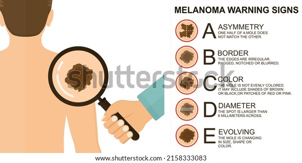 Diagnosis of\
skin cancer. Melanoma warning signs. Dermatological screening. UVB\
prevention of squamous cell treatment. Basal test. ABCDEs of skin\
cancer screening. Man back\
view	\
