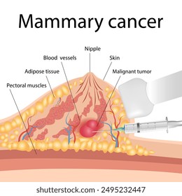 Diagnostic biopsy of breast cancer to obtain a sample. Lateral cross-sectional view of a human female breast showing a mammary gland and an unknown cyst in the fatty tissue