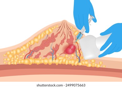 diagnostic biopsy of gastrointestinal cancer under control. diagnostic biopsy of mole cancer after examination opinion in the medical clinic