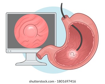 Diagnostics of gastric disease vector illustration. Gastroscopy procedure. 