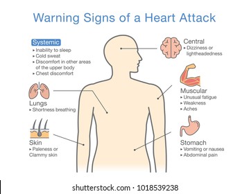 Diagram About Warning Signs Of A Heart Attack. Illustration About Medical Diagram For Diagnose A Disease Or Condition.