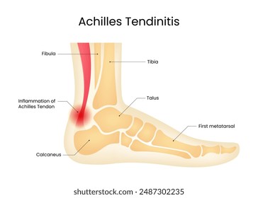 Diagram of Achilles tendinitis symptoms