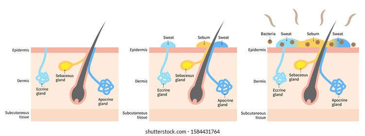 diagram of body odor and sweat glands. Human skin layer illustration for medical and health care use