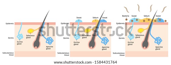 diagram of body odor and\
sweat glands. Human skin layer illustration for medical and health\
care use