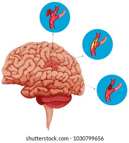 Diagram of brain blocking stroke or aneurism