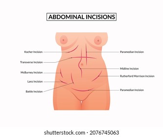 Diagram of Common Surgical Abdominal Incisions.