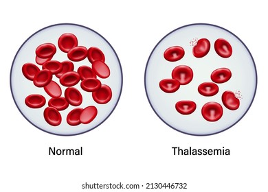Diagram Of Comparison Between Normal Red Blood Cells And Thalassemia.