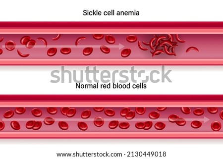Diagram of comparison Blood flow between sickle cell disease and normal blood vessels.
