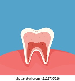 Diagram of a cross section of a tooth showing the layers of enamel, dentin, pulp with blood vessels and nerves. Dental anatomy concept. Vector cartoon illustration.