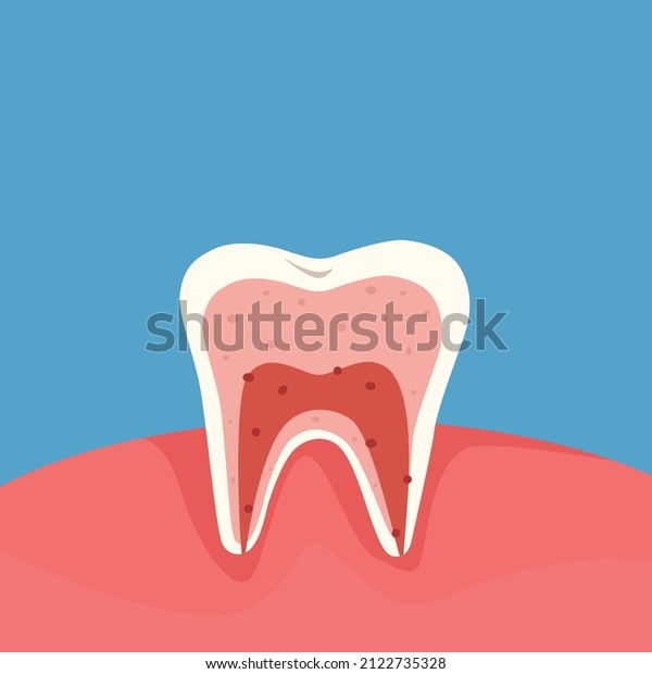 Diagram of a cross section of a\
tooth showing the layers of enamel, dentin, pulp with blood vessels\
and nerves. Dental anatomy concept. Vector cartoon\
illustration.