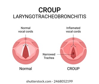 Diagram of Croup Laryngotracheobronchitis disease