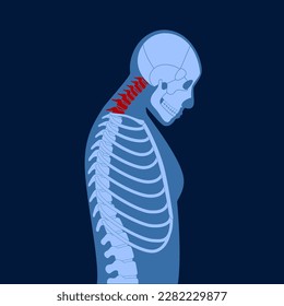 Abbildung der Verformung der Halswirbel. Nackenspasmus, Rückenschmerzen, Steifheit und Schulterspannungen. Gesunde Wirbelsäule und Höcker in männlicher Körpermedizin, Vektorgrafik, Skelett-Silhouette.