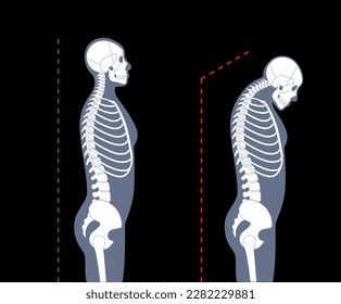 Diagram of deformation of the cervical vertebrae. Neck spasm, pain in spine, stiffness and tightness in shoulders. Healthy spine and hump in male body medical vector illustration, skeleton silhouette.