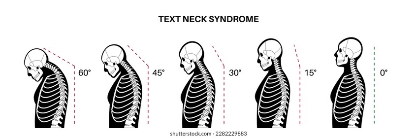 Diagram of deformation of the cervical vertebrae. Neck spasm, pain in spine, stiffness and tightness in shoulders. Healthy spine and hump in male body medical vector illustration, skeleton silhouette.