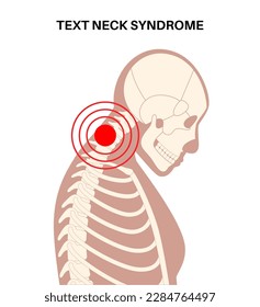 Diagram of deformation of the cervical vertebrae. Neck spasm, pain in spine, stiffness and tightness in shoulders. Healthy spine and hump in male body medical vector illustration, skeleton silhouette.